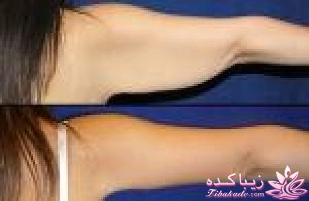 لیپولیز - لیپوماتیک - لیپوساکشن